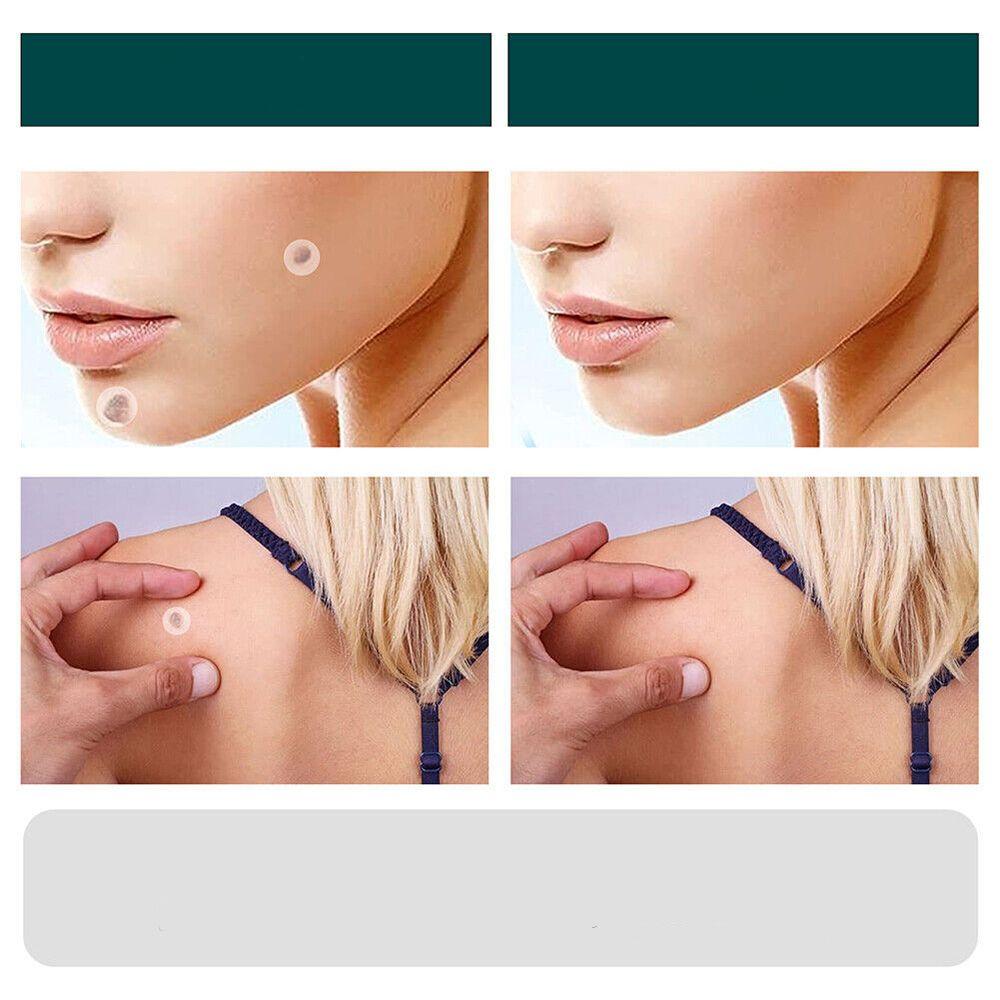 Skin Tag Patches | Hydrocolloid Adhesive Patches with Tea Tree Oil | Discreet Skin Care Patches | 120 Count